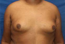 Before Results for Gynecomastia