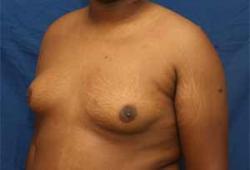 Before Results for Gynecomastia