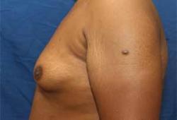 Before Results for Gynecomastia