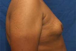 Before Results for Gynecomastia