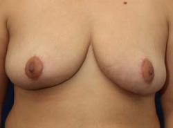 After Results for Breast Reduction