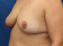 After Results for Breast Reduction