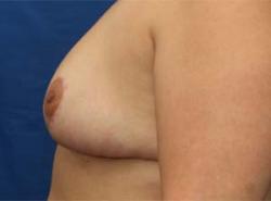 After Results for Breast Reduction