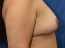 After Results for Breast Reduction