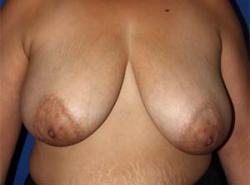 Before Results for Breast Reduction