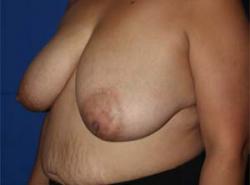 Before Results for Breast Reduction