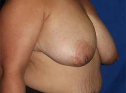 Before Results for Breast Reduction