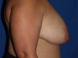 Before Results for Breast Reduction
