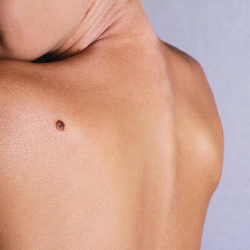 Skin Cancer Treatment in San Antonio